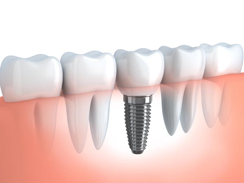 Dental Implants  New Lebanon, OH 